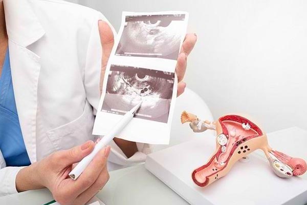 endometriosis-causas-sintomas-tratamiento7