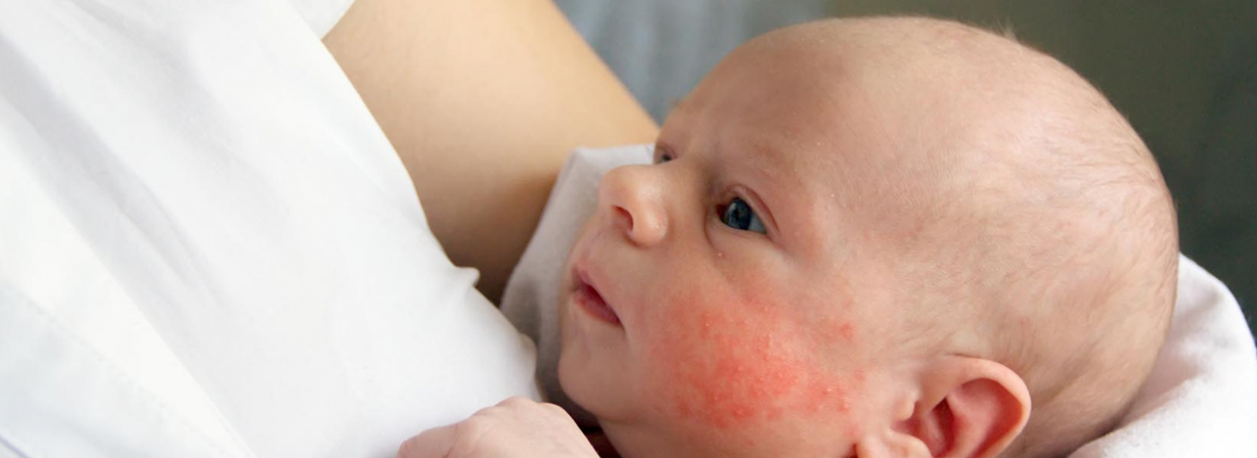 Tu bebé puede contraer herpes neonatal de esta manera