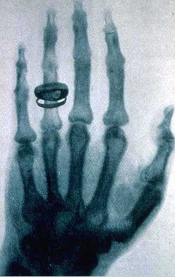 radiografia tomada por wilhelm r�ntgen en 1896